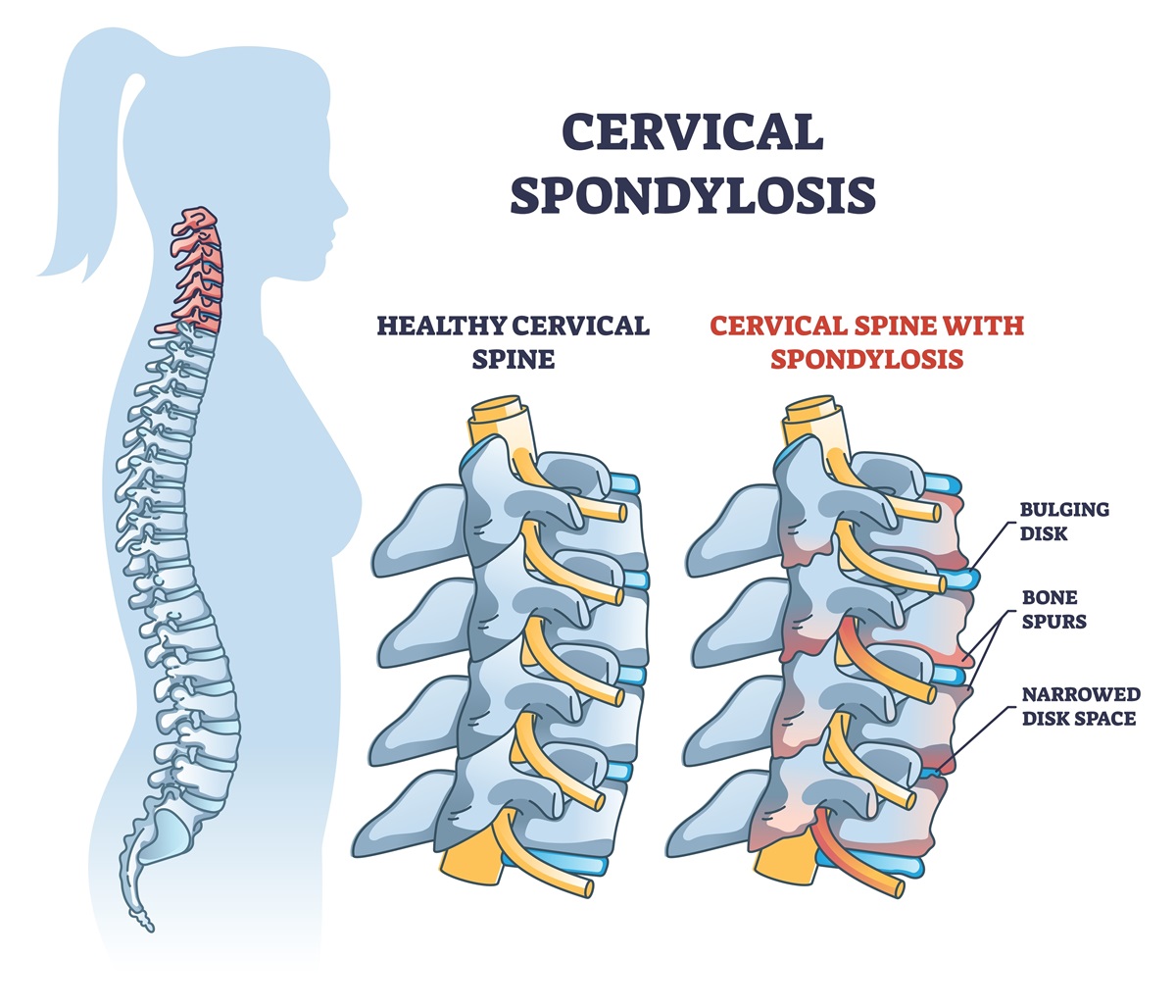 Spondylóza: degeneratívne ochorenie stavca a medzistavcovej platničky